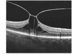 Vitreous Traction Syndrome