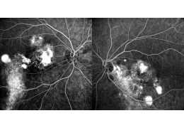 Chronic Central Serous Chorioretinopathy