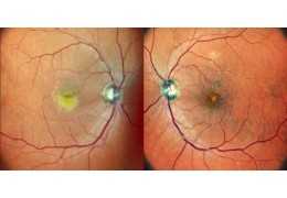 Macular Vitelliform Dystrophy (Best's Disease)