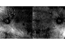 Retinal Alterations in Patient with Erdheim's Disease Treated with Cobimetinib