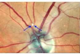 Retinal Arterial Branch Occlusion (BRAO)