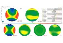 Keratoconus in Homozygotic Twins