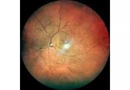 Alberto Bellone: Neurosensory Retinal Detachment Due to Treatment with Sunitinib